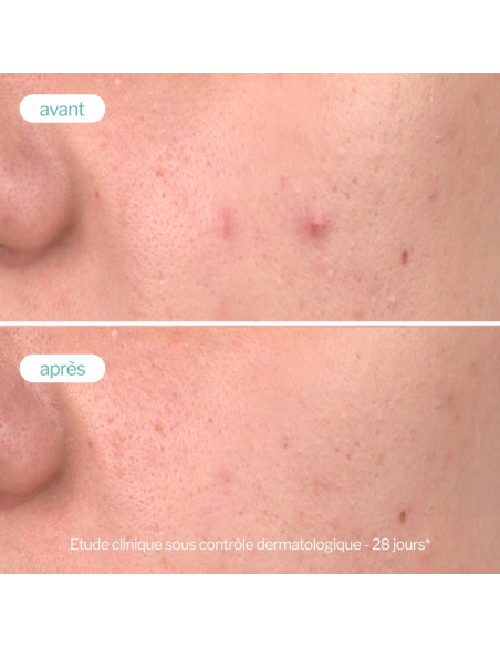 Novexpert Soin Peeling Peau Nette