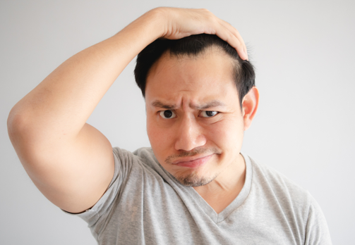 Chute de cheveux chez l'homme : Solutions et Prévention